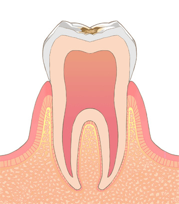 【C1】エナメル質内部まで溶けた状態