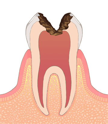 【C3】歯の神経（歯髄）まで達した状態