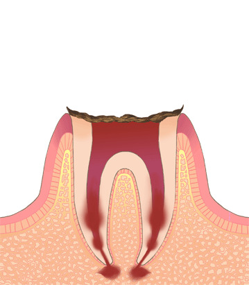 【C4】歯が崩壊して、根だけの状態