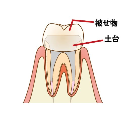 6. 土台の設置とクラウン装着