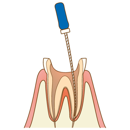 2. 歯髄の除去