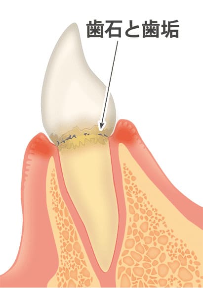 歯周病の初期段階（軽度歯肉炎）