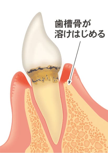 歯周病の中期段階（中等度歯周炎）