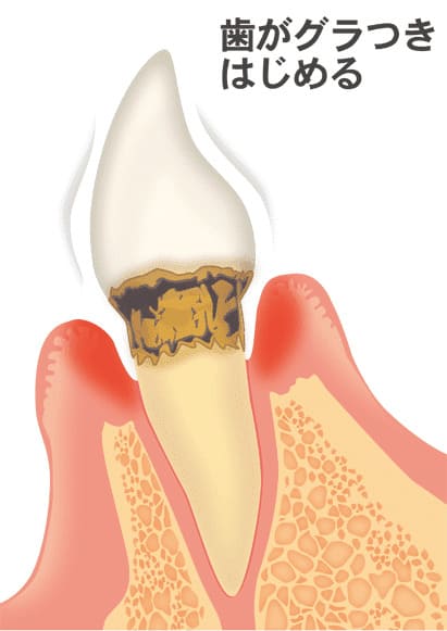 歯周病の進行段階（重度歯周炎）