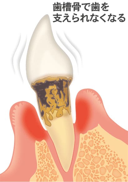 歯周病の末期段階